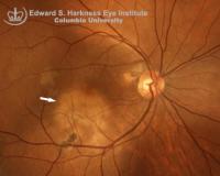 32-year-old hispanic male presented with a visual acuity of counting finger. The patient had similar episode in the left eye in the previous year. Note an active lesion with a relatively sharp border involving the fovea of the right eye (white arrow).